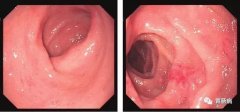 萎縮性胃炎不可怕，只要